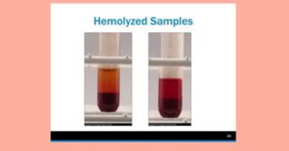 Does Hemolyzed Mean Intact?