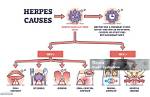 Does Herpes Cause Pyuria?