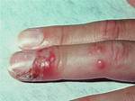 Does Herpetic Whitlow Spread?