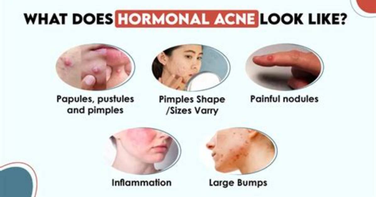Does Hormonal Changes Cause Pimples?