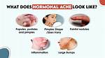 Does Hormonal Changes Cause Pimples?