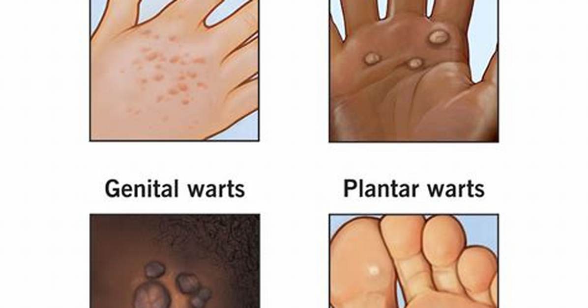 Does Hpv Cause Warts?