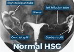 Does Hsg Test Affect Ovulation?