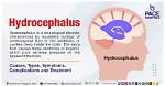 Does Hydrocephalus Cause Headaches?