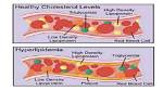Does Hyperlipidemia Cause Gout?
