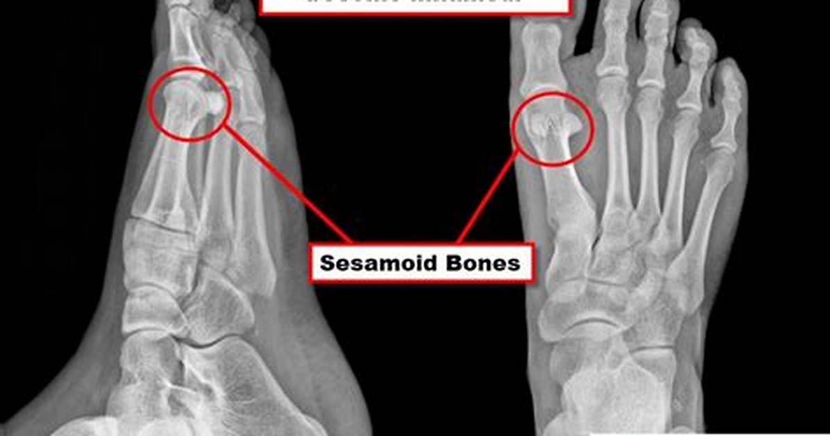 Does Ice Help Sesamoiditis?