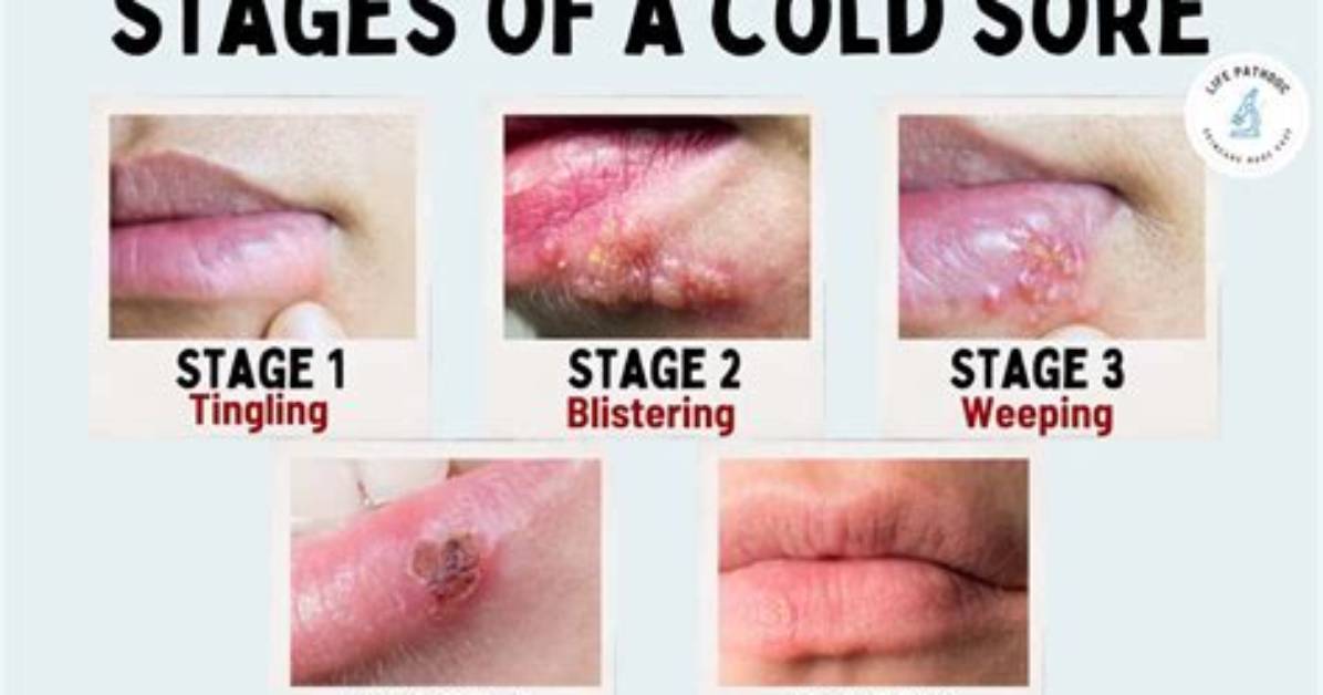 Does Ice Work on Cold Sores?