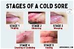 Does Ice Work on Cold Sores?