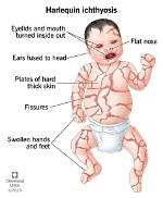 Does Ichthyosis Causes Pain?