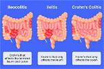 Does Ileitis Go Away