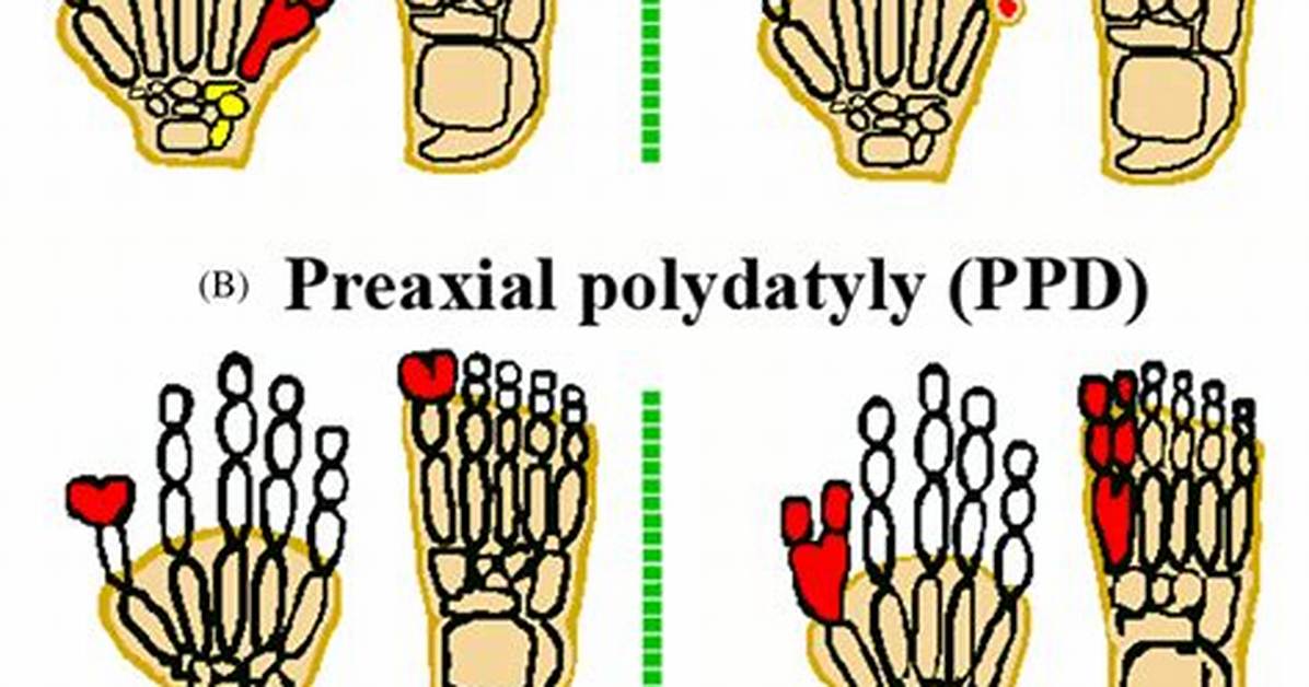 Does Inbreeding Cause Polydactyly?