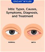 Does Iritis Cause Headaches?