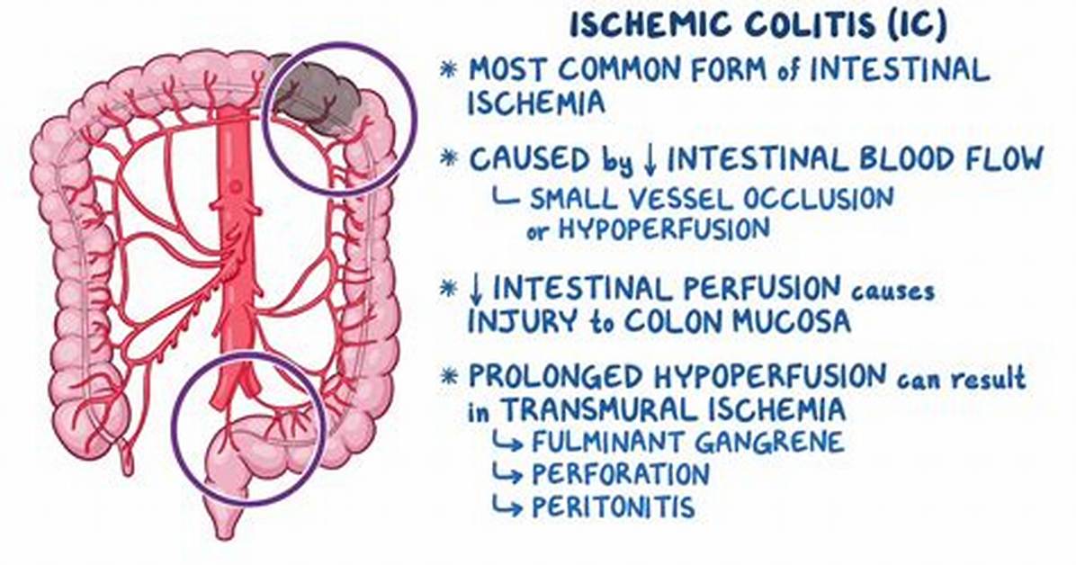 Does Ischemic Colitis Go Away?
