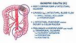 Does Ischemic Colitis Go Away?