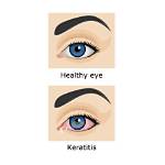 Does Keratitis Go Away