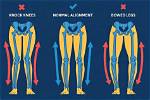 Does Knock Knees Affect Running?