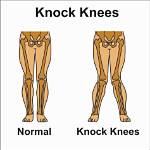 Does Knock Knees Mean?