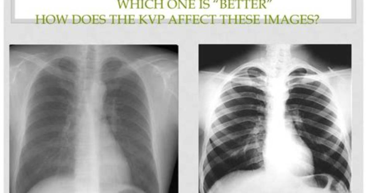 Does kVp Affect Contrast