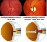 Does Large Optic Nerve Mean Glaucoma