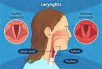 Does Laryngitis Need Antibiotics?