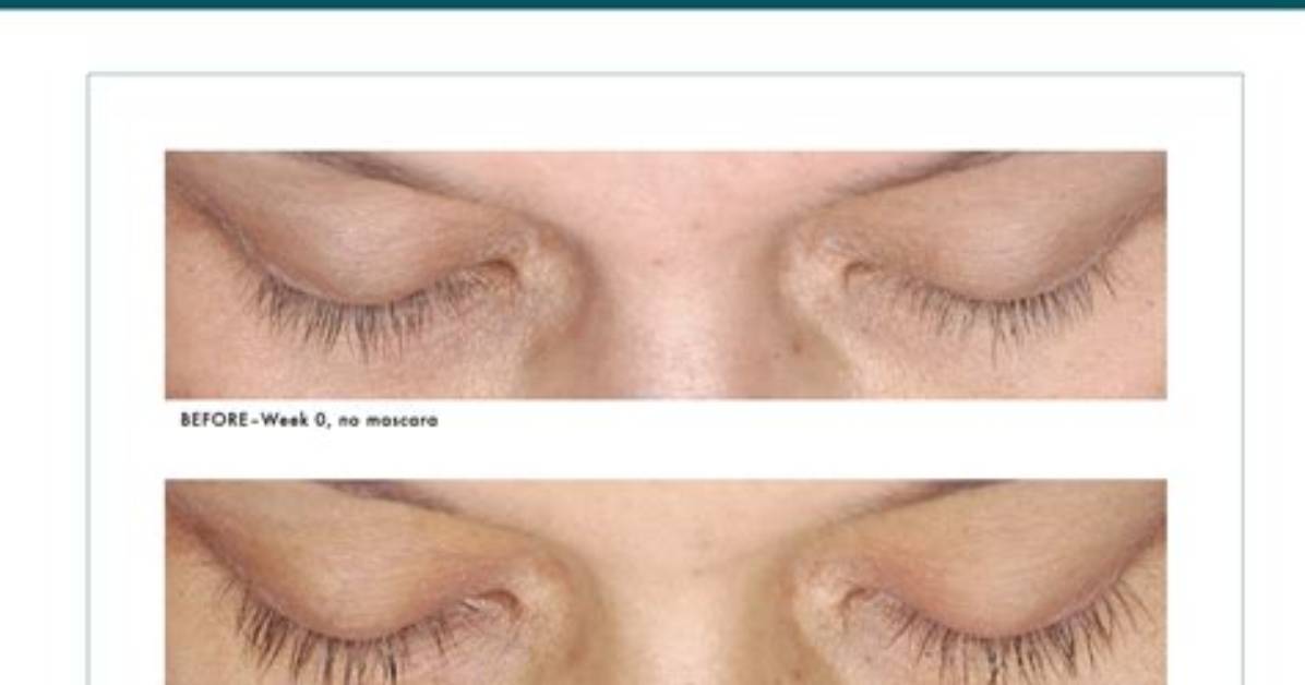 Does Latisse Stop Working?