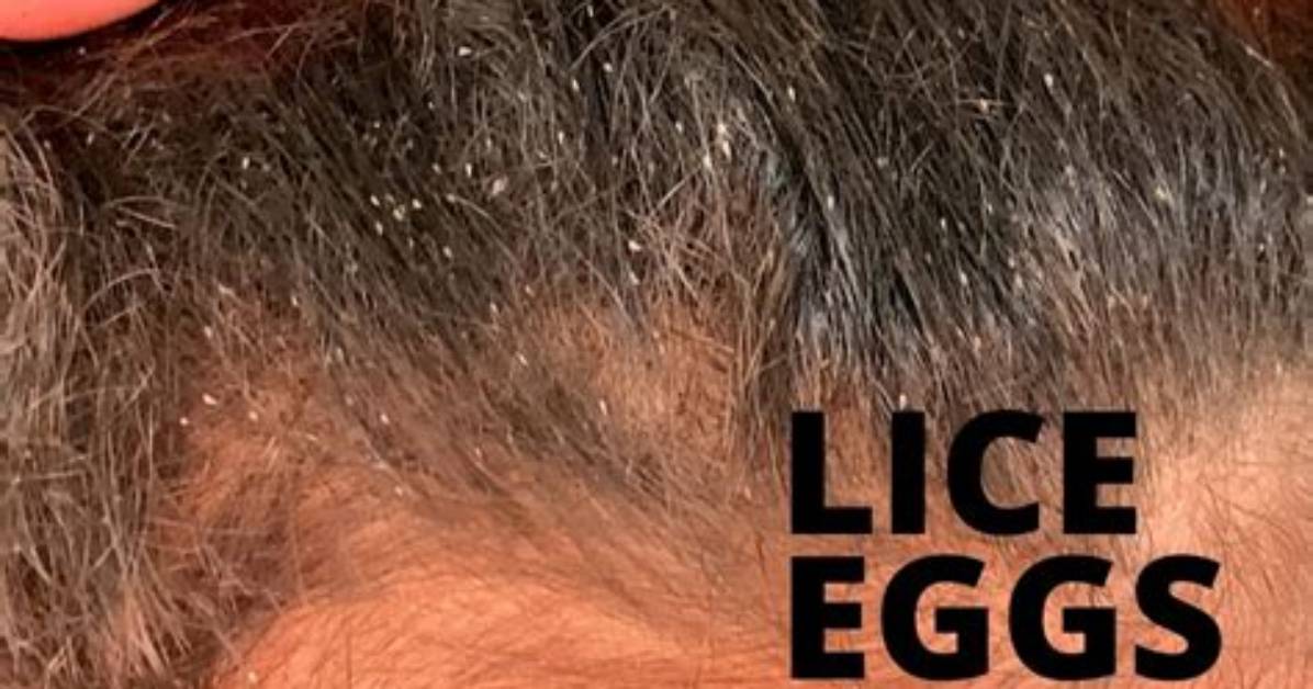 Does Lindane Kill Lice Eggs?