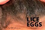 Does Lindane Kill Lice Eggs?