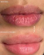 Does Lip Blushing Fade?