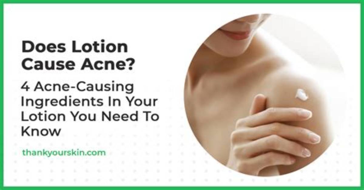 Does Lotion Cause Acne?