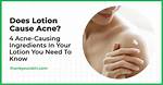 Does Lotion Cause Acne?