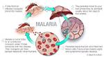 Does Malaria Have a Cure?