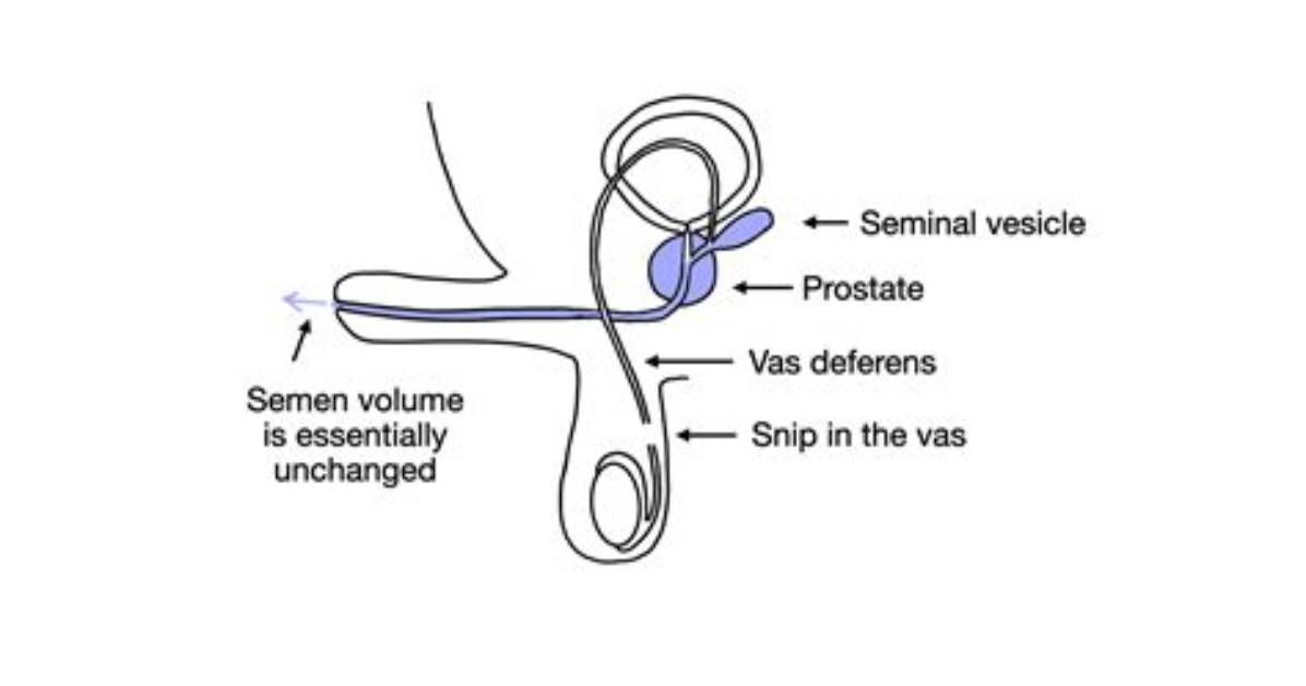 Does Man Still Ejaculate After Vasectomy?