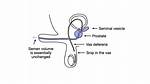 Does Man Still Ejaculate After Vasectomy?