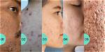 Does Massaging Help Acne Scars?