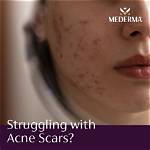 Does Mederma Really Works?