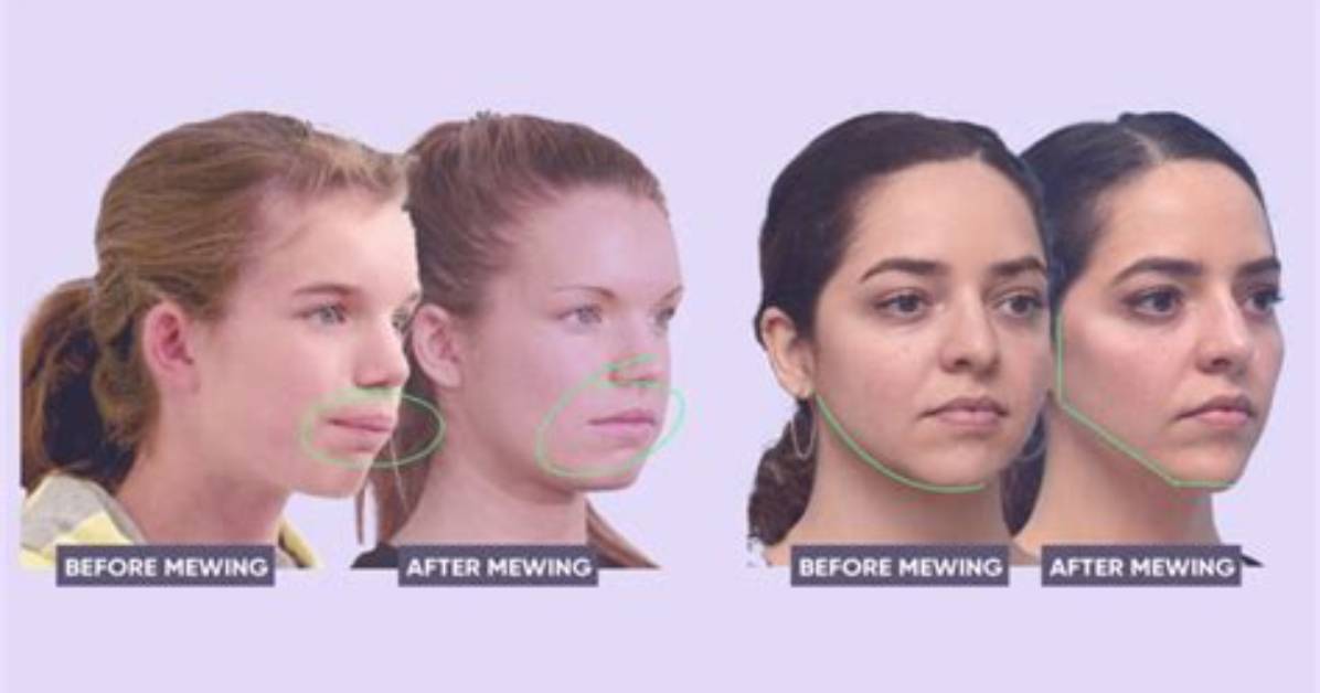 Does Mewing Help Cheekbones?