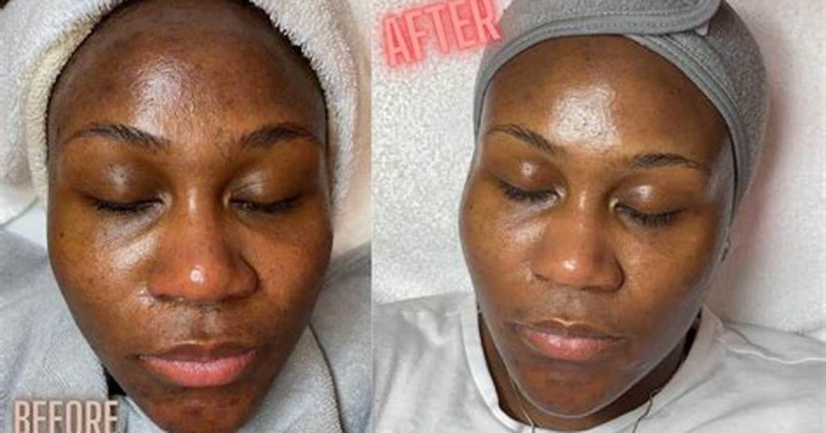Does Microdermabrasion Remove Hyperpigmentation?