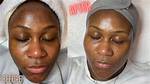 Does Microdermabrasion Remove Hyperpigmentation?