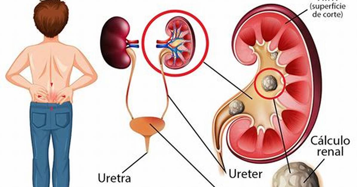 Does Microlithiasis Cause Pain?