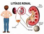 Does Microlithiasis Cause Pain?