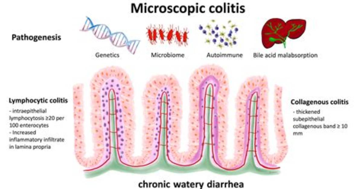 Does Microscopic Colitis Recur?