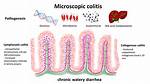 Does Microscopic Colitis Recur?