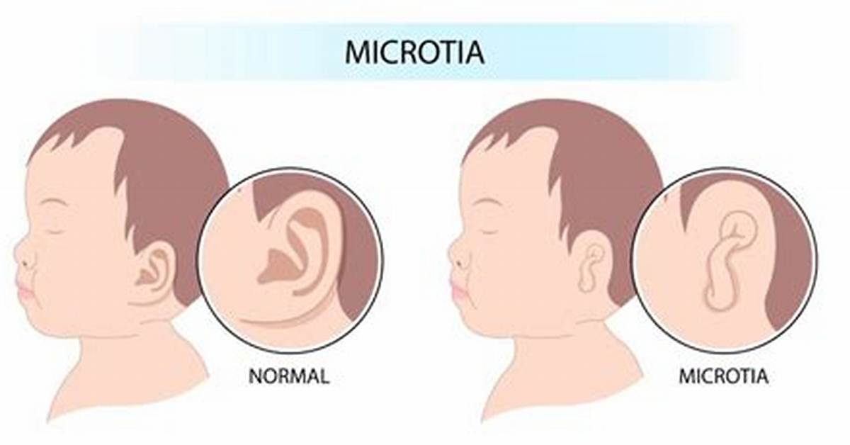 Does Microtia Affect Speech?