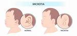 Does Microtia Affect Speech?