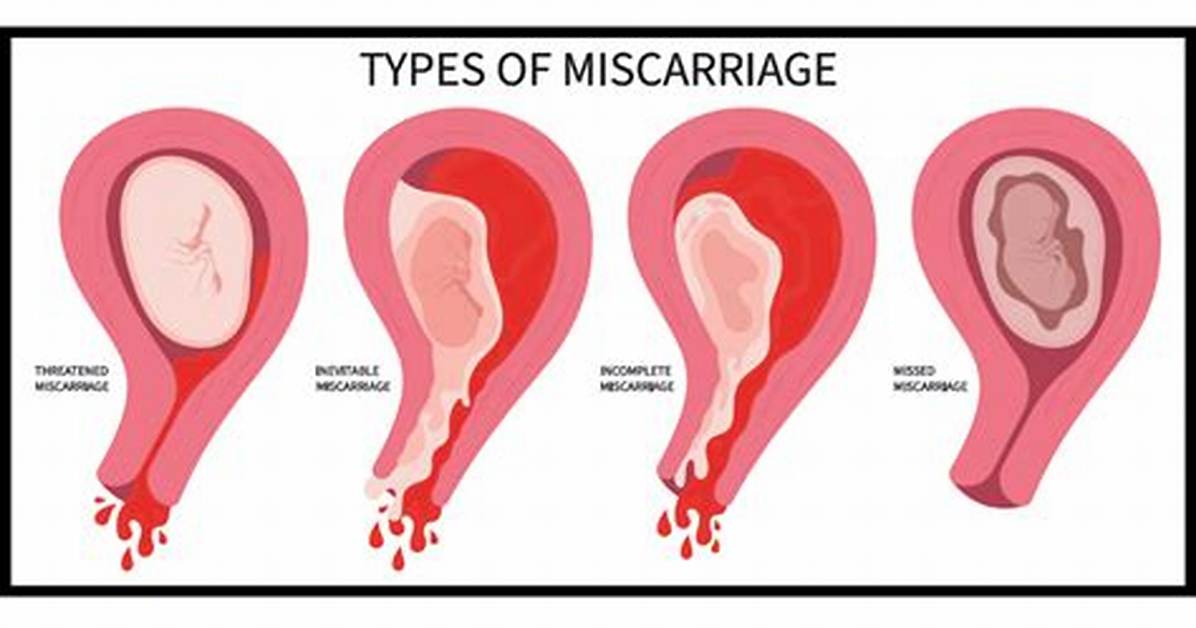 Does Miscarriage Mean Miscarriage?