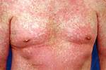 Does Morbilliform Rash Itch?
