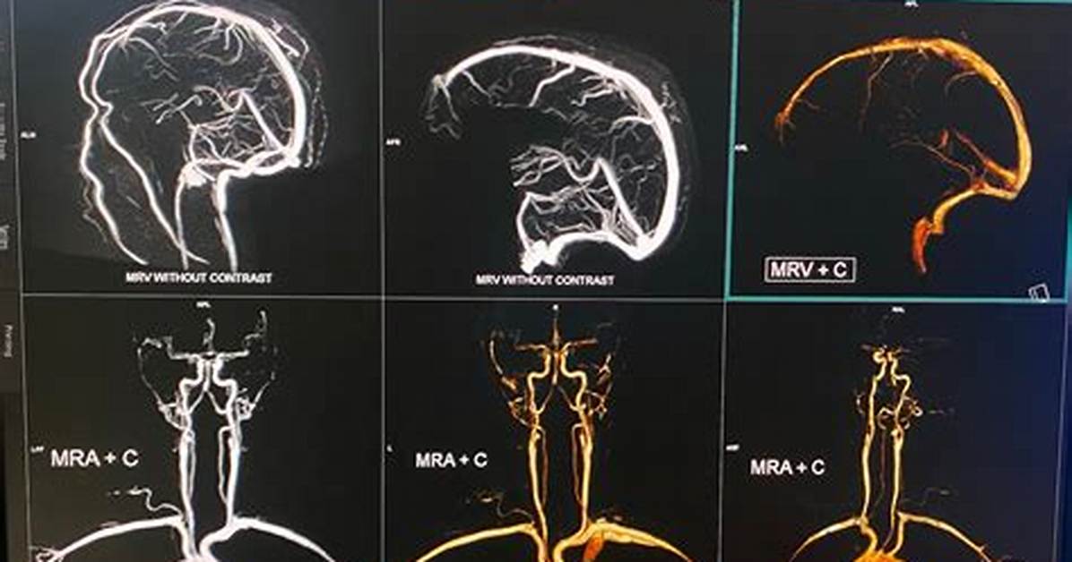 Does Mr Venogram Use Contrast?