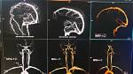 Does Mr Venogram Use Contrast?