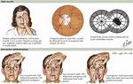 Does Ms Cause Scotoma?