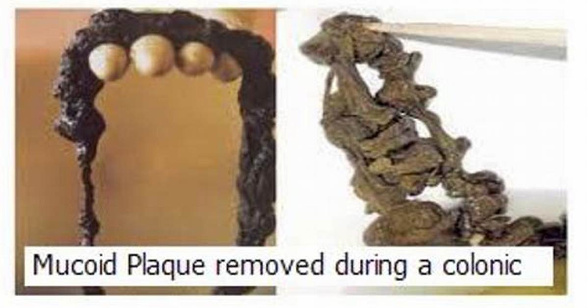 Does Mucoid Plaque Exist?